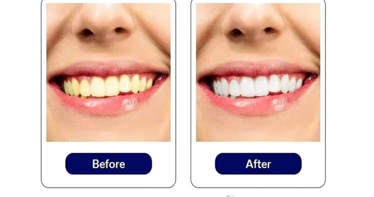 Simple Home Portable Teeth Whitestrips – Fast, Easy & Effective Whitening Anywhere