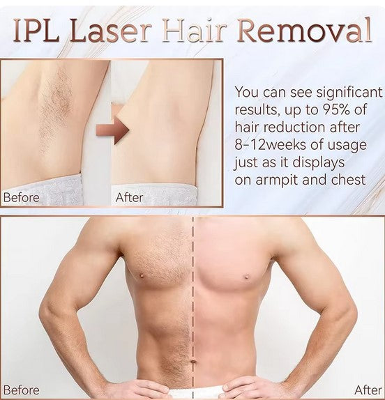 IPL Laser Permanent Hair Removal Device